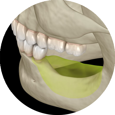 3d model of bone augmentation