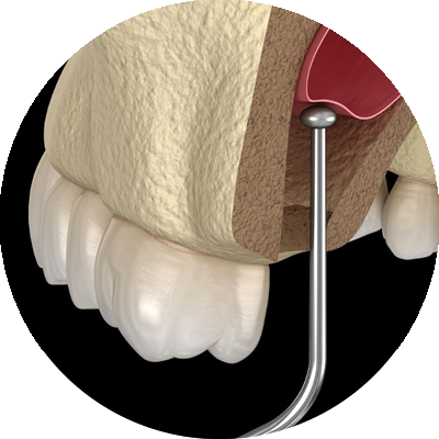 3d model of sinus lift