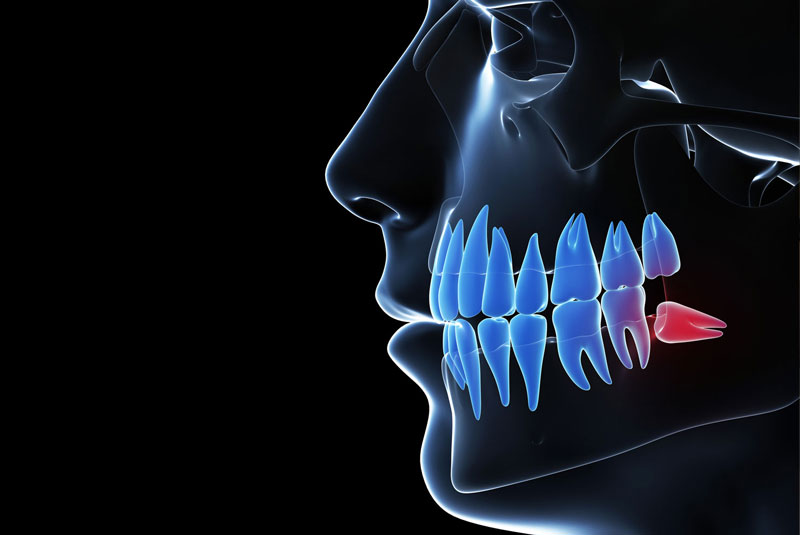 impacted wisdom tooth graphic