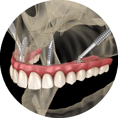 zygomatic dental implant 3d model