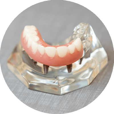 full arch dental implant model placed on counter