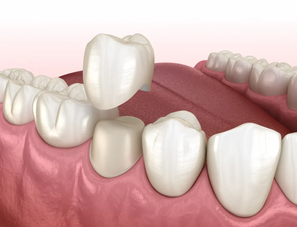 dental crown