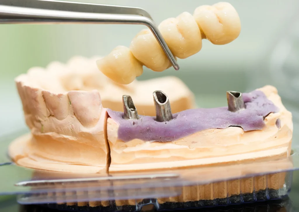 dental implant vs bridge