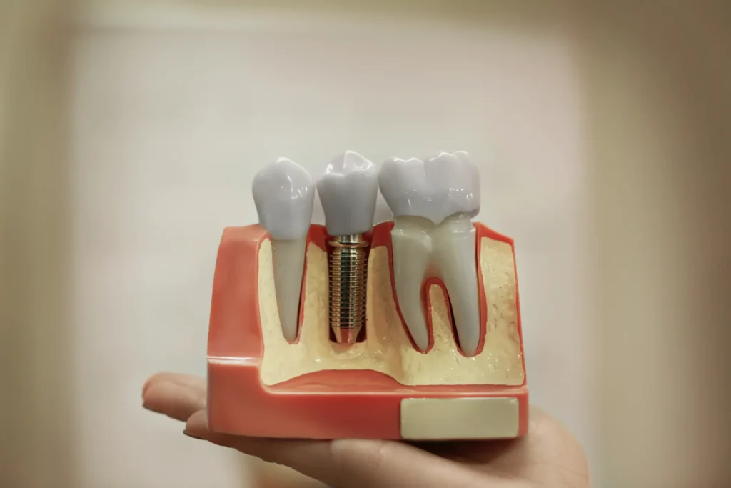 dental implants