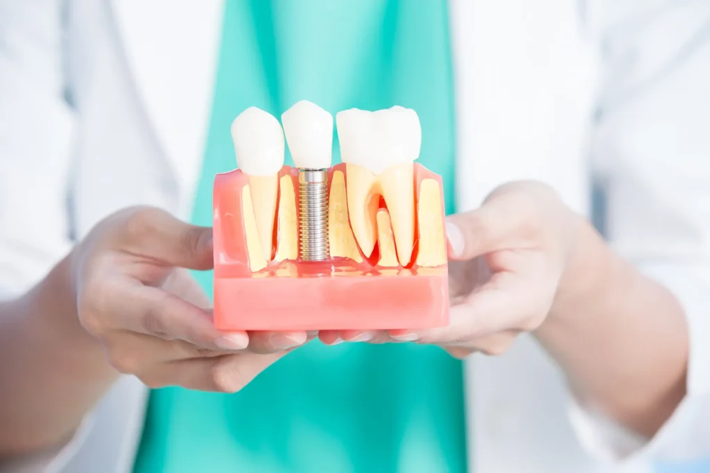 what are dental implants