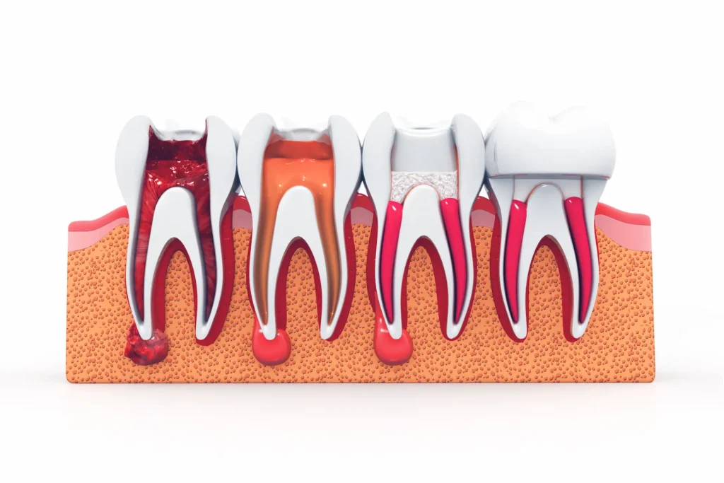 what is root canal