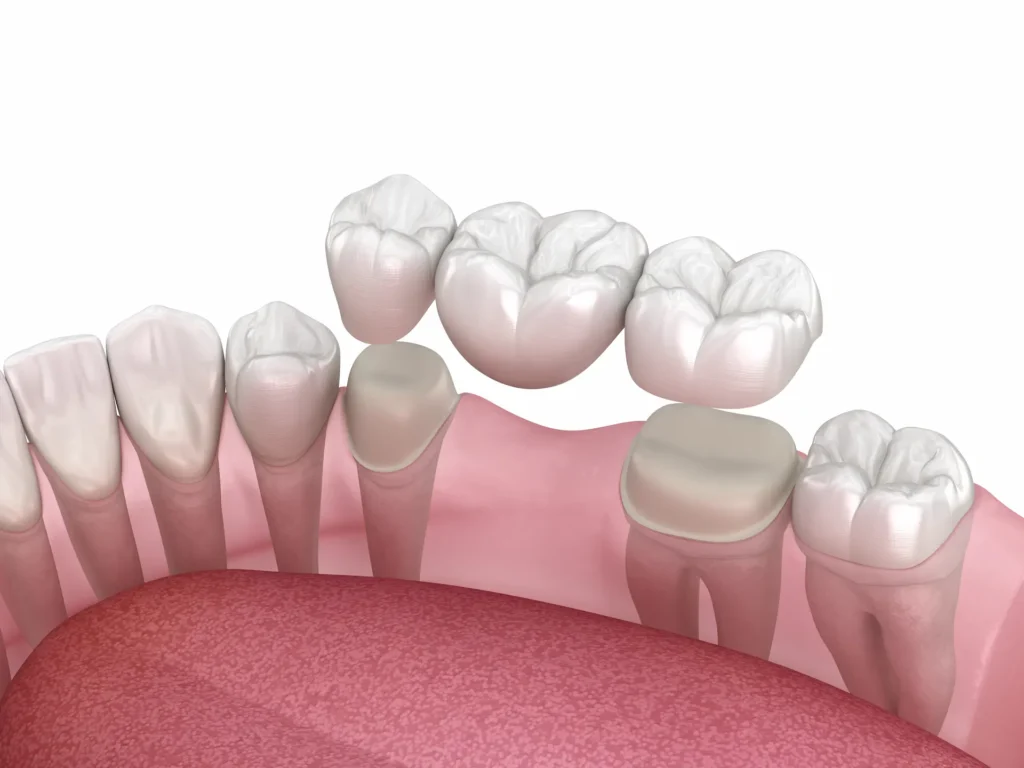 dental bridge