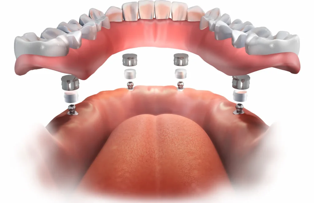 all on 4 dental implant system