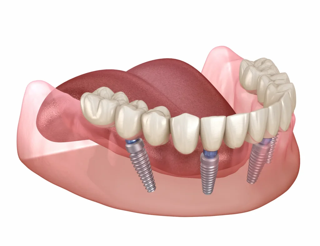 all on 4 dental implants