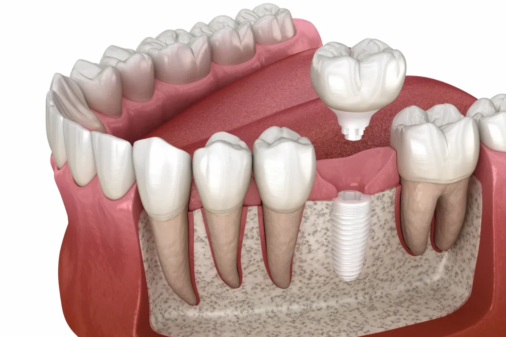 ceramic dental implants