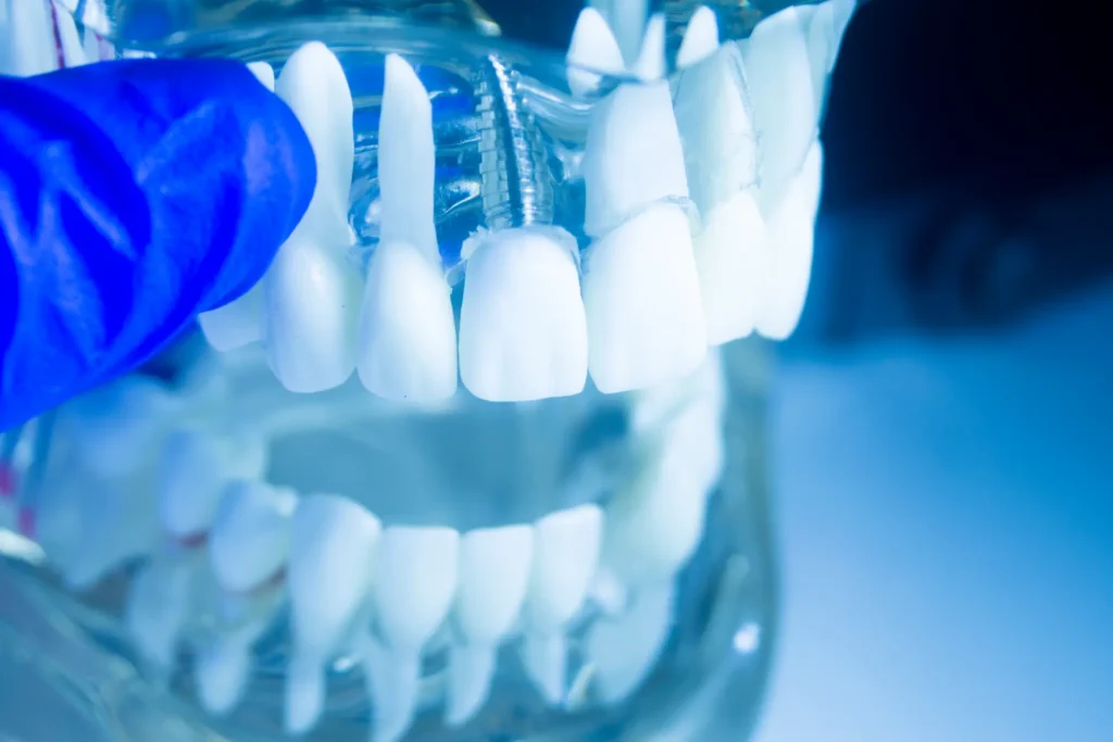 Dental Implant Advantages vs Disadvantages