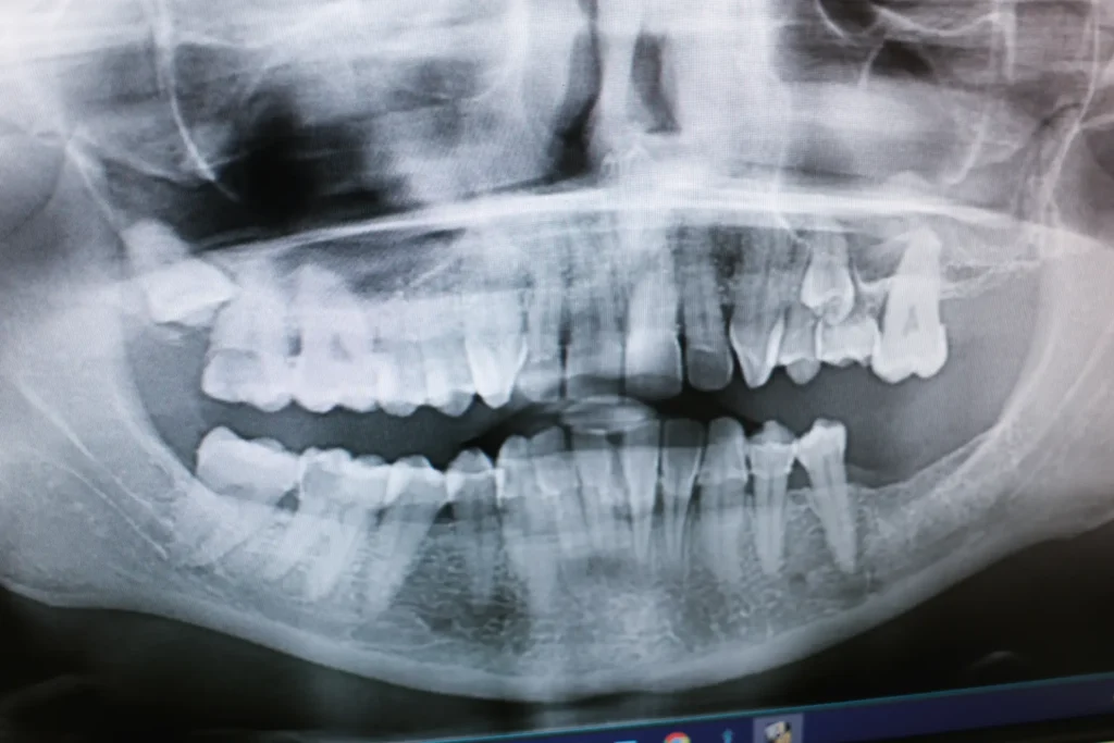 Dental Implant Procedure