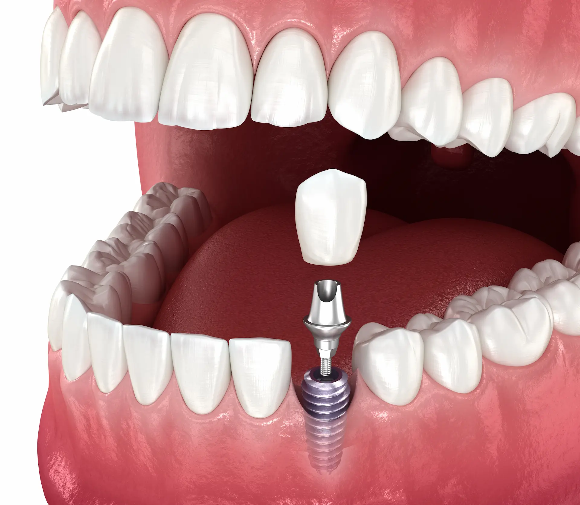 how is dental implant done