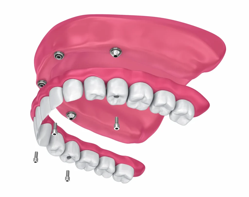 snap on dentures