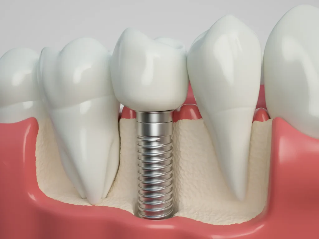 titanium dental implants