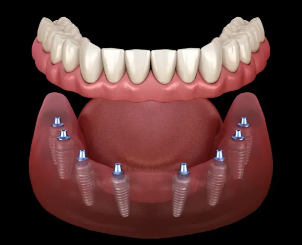 Understanding All-on-8 Dental Implants