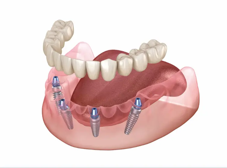 What are All-on-4 Dental Implants?