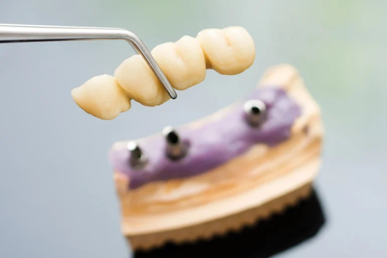 What Are Denture Implants