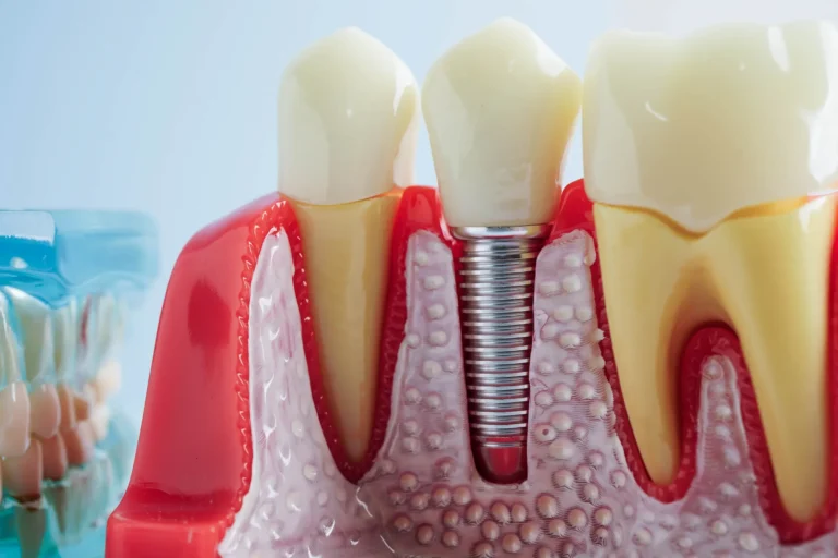 What Are the Signs of Dental Implant Failure?